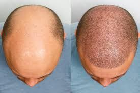Hair Transplant in Gujarat: The Most Effective Solution for Hair Fall & Hair Loss