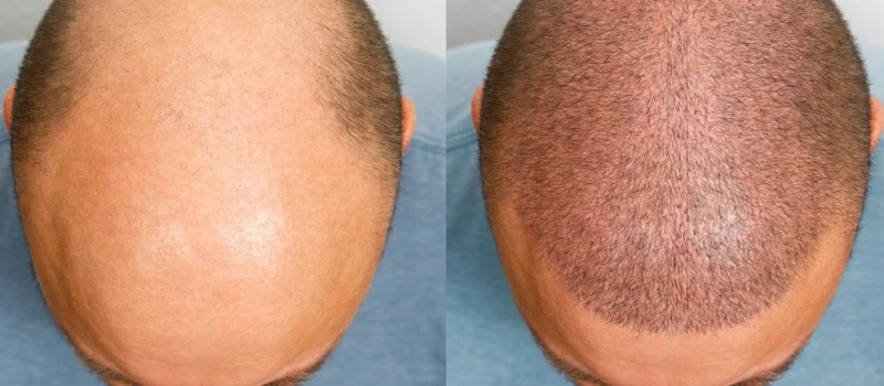 -hair-transplant